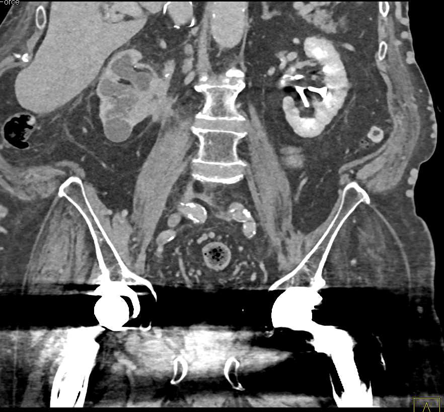 Transitional Cell Carcinoma (TCC) Right Renal Pelvis - CTisus CT Scan