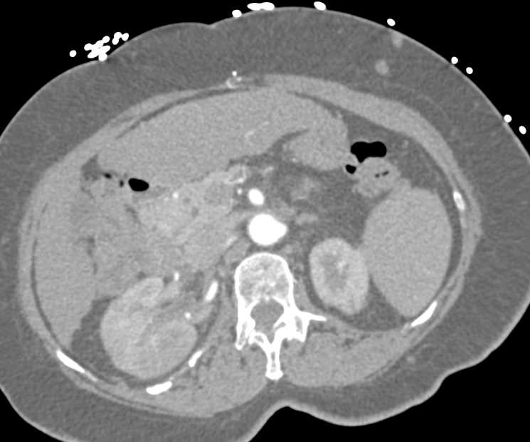 Acute Pyelonephritis Right Kidney in Patient with Cirrhosis - CTisus CT Scan