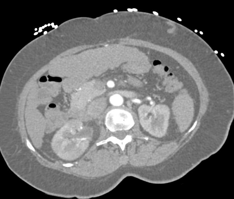 Acute Pyelonephritis Right Kidney in Patient with Cirrhosis - CTisus CT Scan