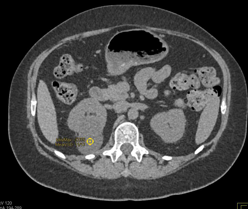 Papillary Renal Cell Carcinoma - CTisus CT Scan