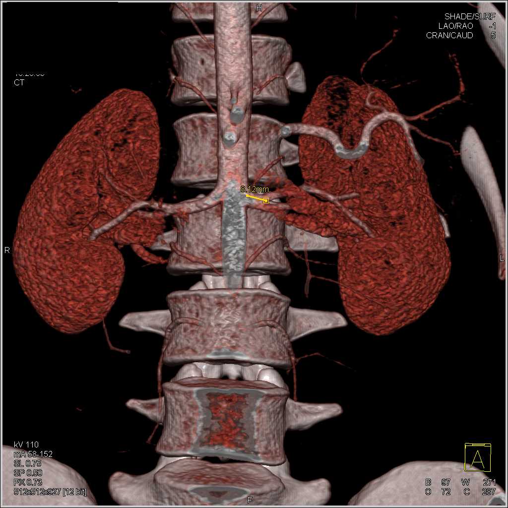 Prehilar Branching of the Left Renal Artery - CTisus CT Scan