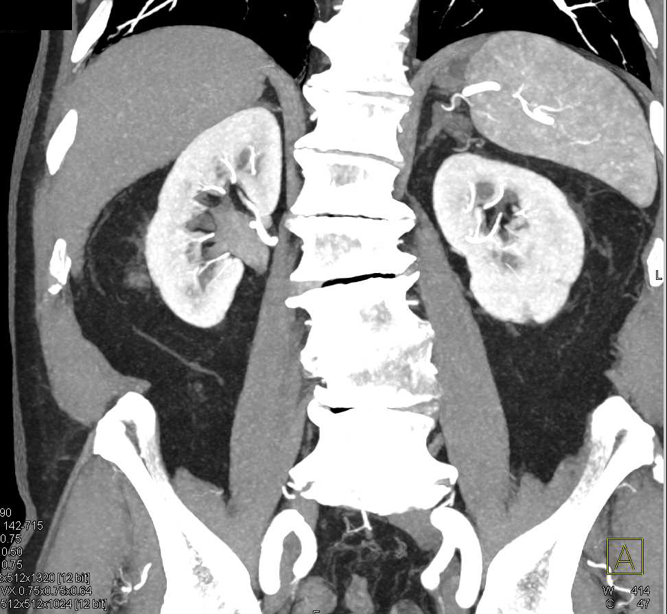 Transitional Cell Carcinoma (TCC) Right Renal Pelvis - CTisus CT Scan