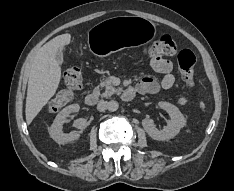 Transitional Cell Carcinoma (TCC) Right Renal Pelvis - CTisus CT Scan