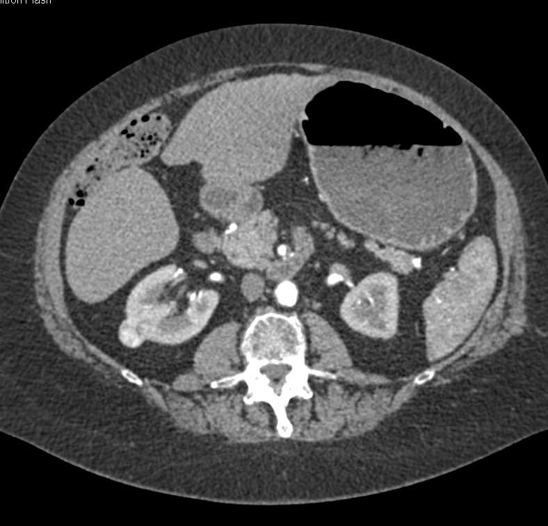 2cm Renal Cell Carcinoma Right Kidney - CTisus CT Scan