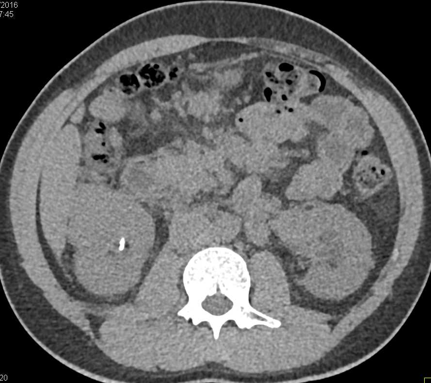 Delayed Left Renal Function and Adenopathy - CTisus CT Scan