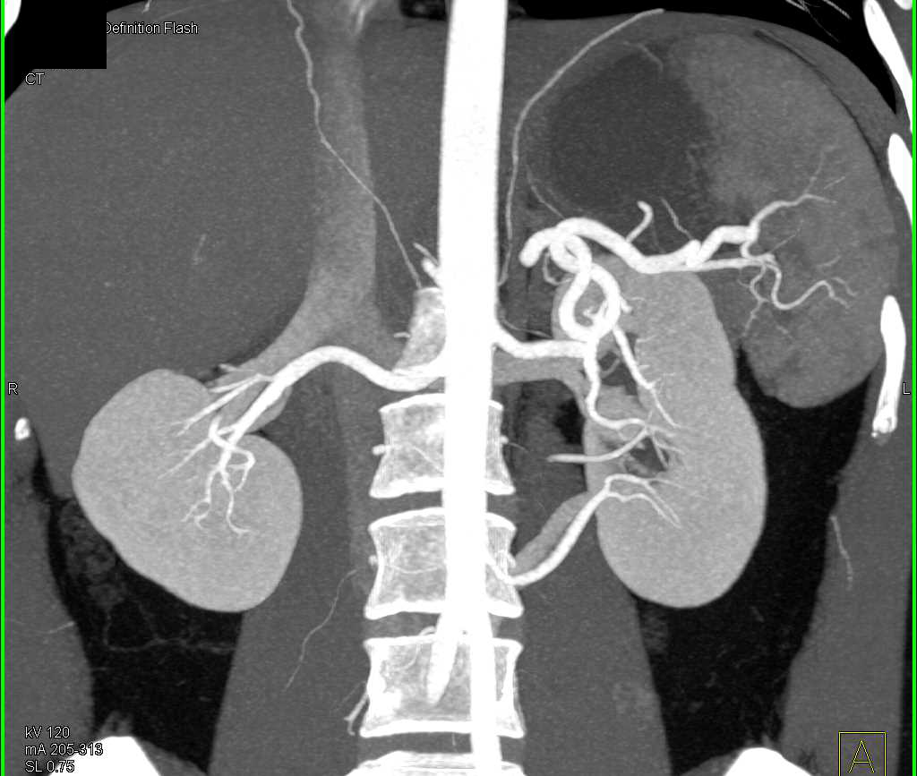 Normal CT Urography - CTisus CT Scan