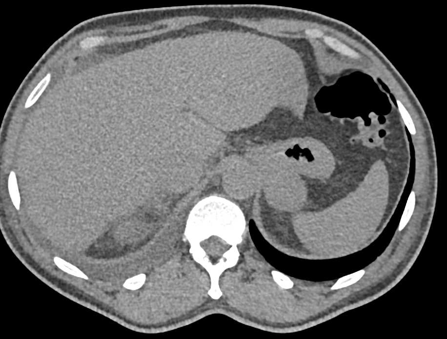 Renal Cell Carcinoma with Venous Invasion - CTisus CT Scan