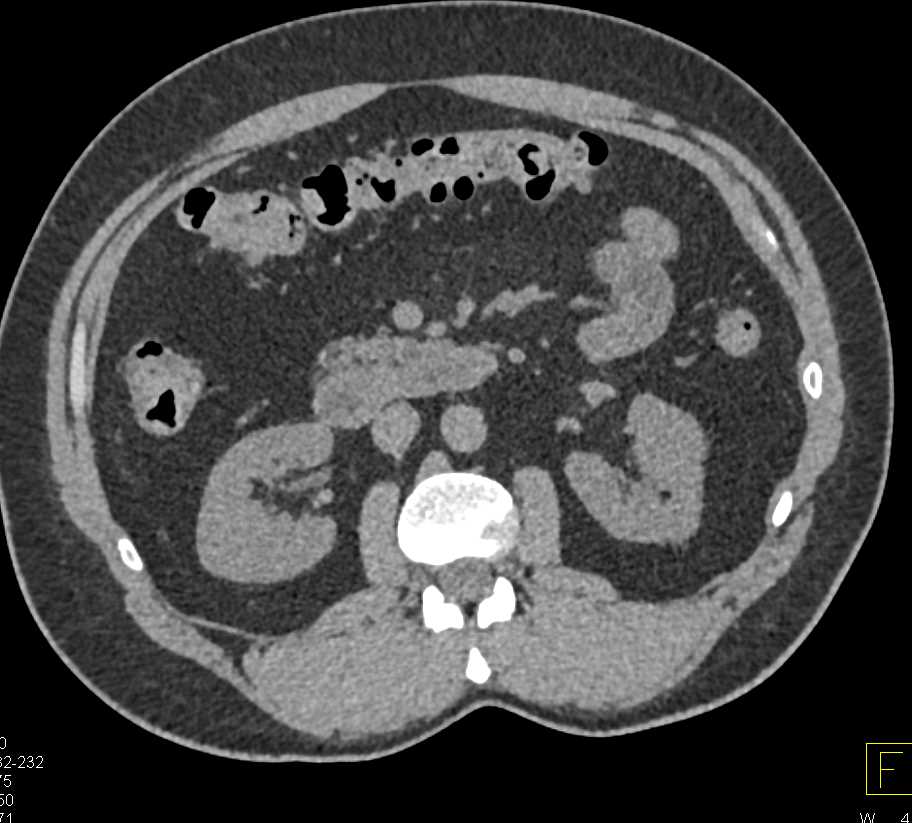 Plaque in the Left Renal Artery - CTisus CT Scan