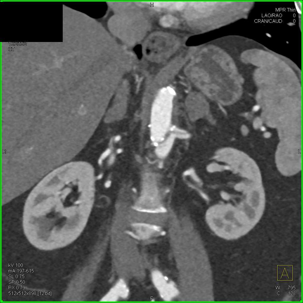 Aortic Dissection Tracts into the Left Renal Artery - CTisus CT Scan
