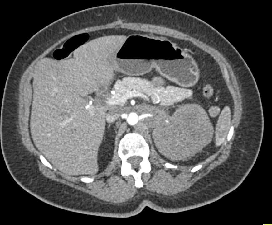 Transitional Cell Carcinoma Infiltrates the Left Kidney - CTisus CT Scan