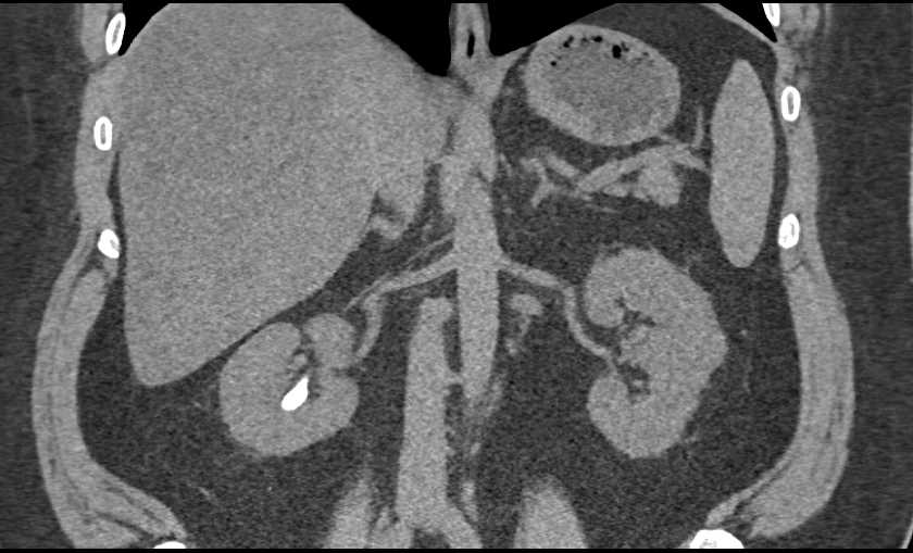 Right Renal Calculus - CTisus CT Scan