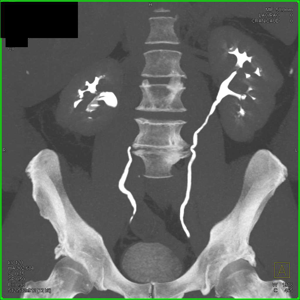 Right Renal Calculus - Kidney Case Studies - CTisus CT Scanning