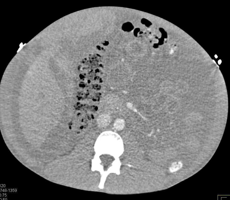 Renal Transplant in the Right Lower Quadrant - CTisus CT Scan
