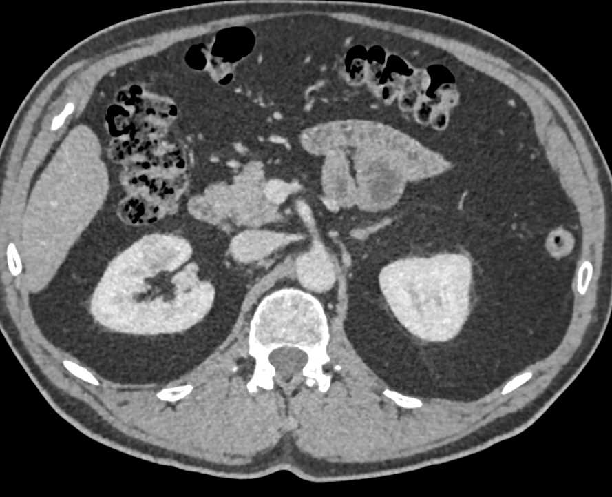 Subtle 1cm Right Renal Cell Carcinoma - CTisus CT Scan