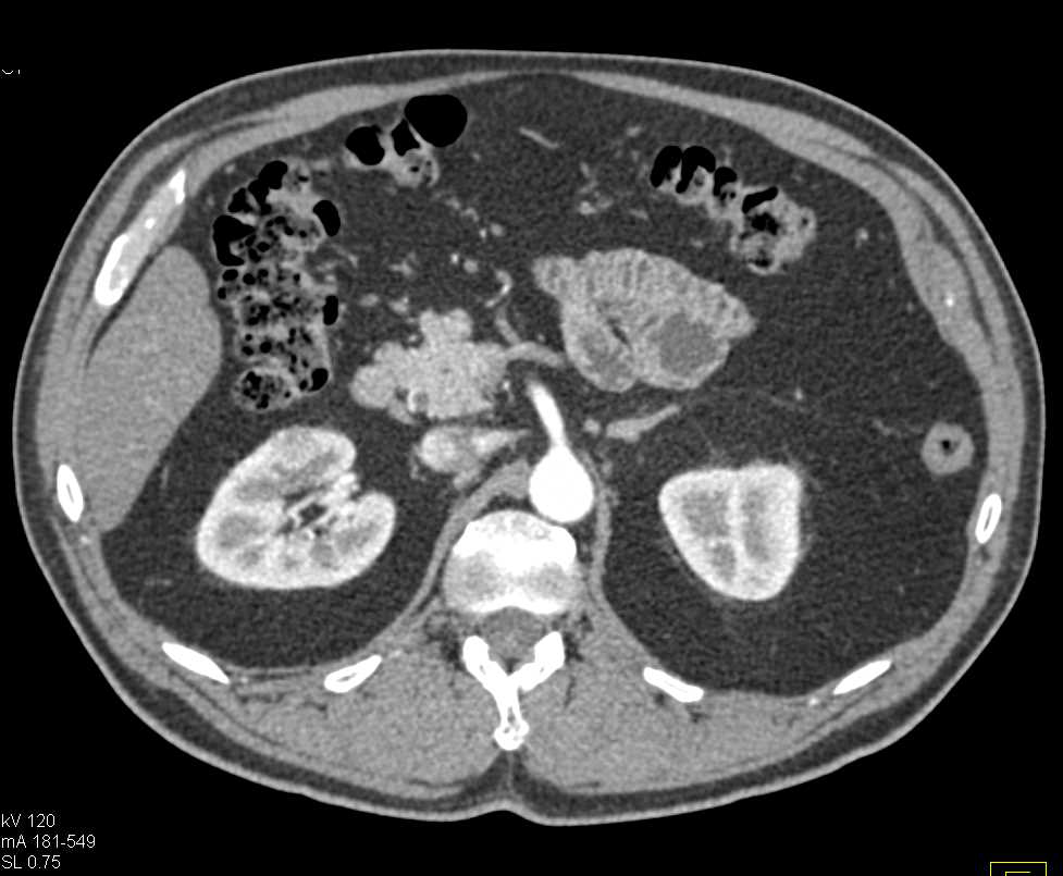 Subtle 1cm Right Renal Cell Carcinoma - CTisus CT Scan