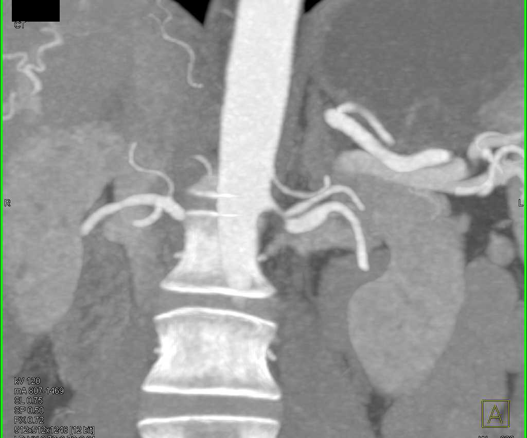 Left Renal Artery Stenosis - CTisus CT Scan