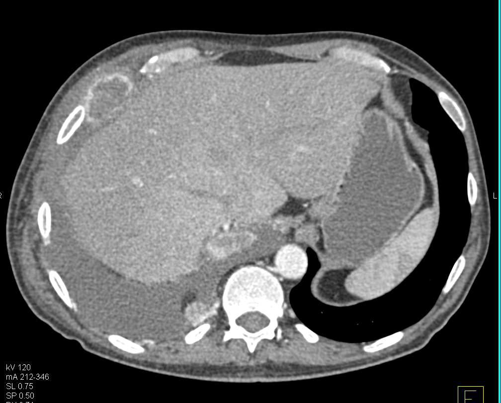 Metastatic Renal Cell Carcinoma to Muscle, Bone and Pleura - CTisus CT Scan