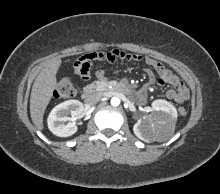 Bosniak 2F Cyst Left Kidney - CTisus CT Scan