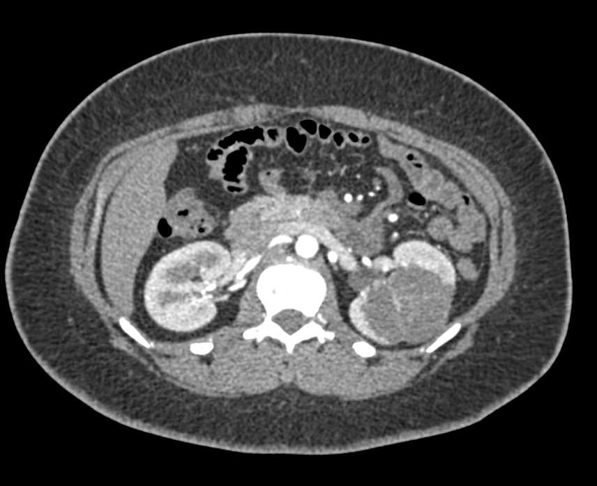 Bosniak 2F Cyst Left Kidney - CTisus CT Scan