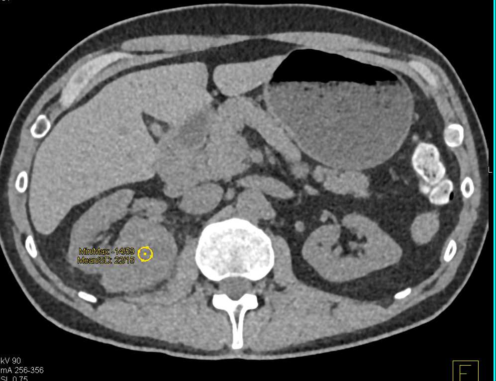 Clear Cell Renal Cell Carcinoma - CTisus CT Scan