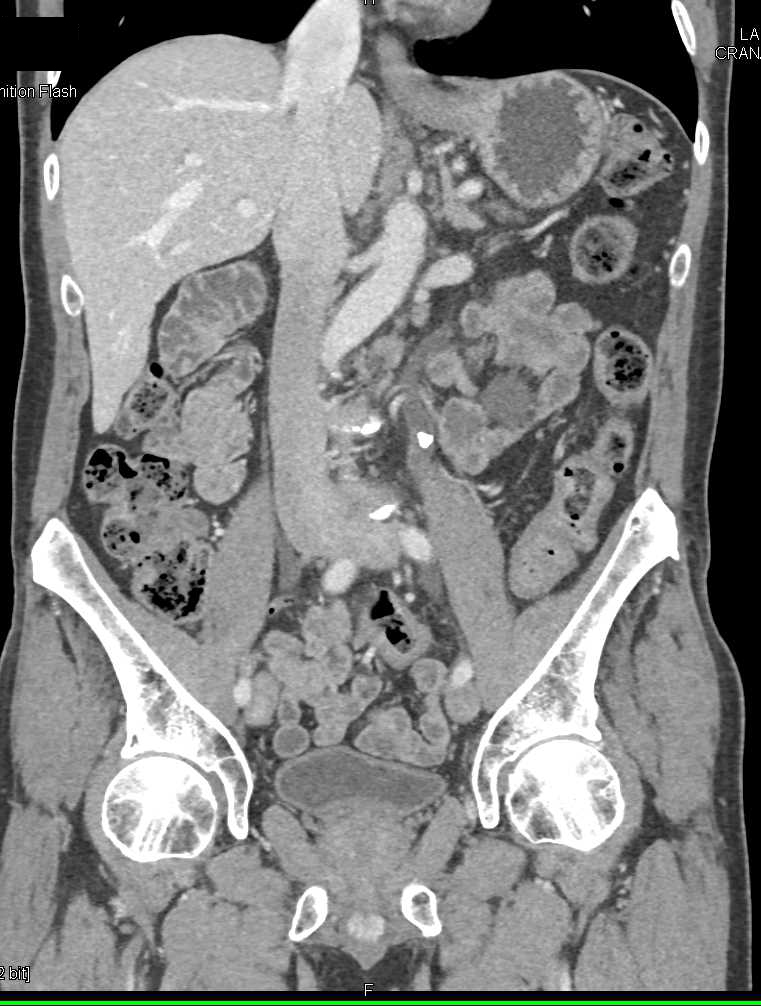Obstructing Stone in the Left Ureter - CTisus CT Scan