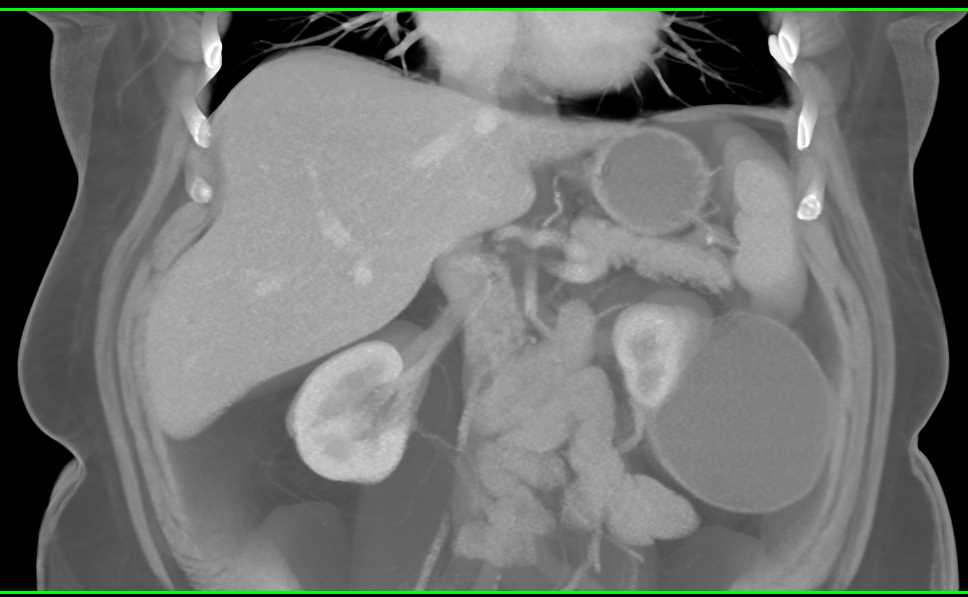 Bosniak 2 Cyst Left Kidney - CTisus CT Scan