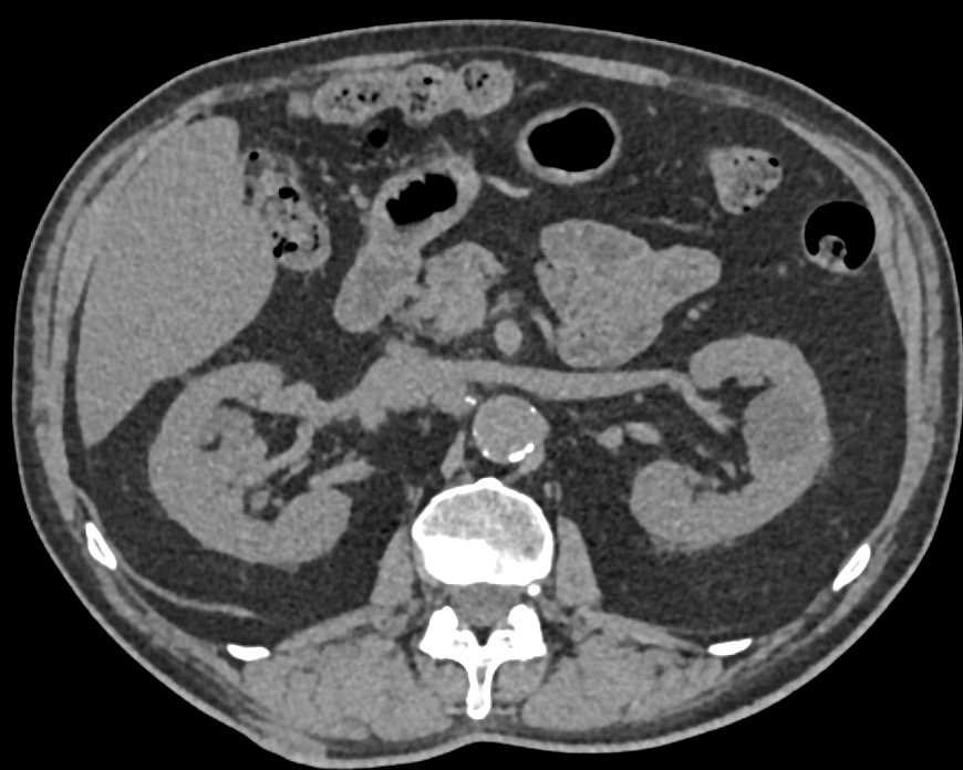 Renal Cell Carcinoma Right Kidney with Arteriovenous (AV) Fistulae - CTisus CT Scan