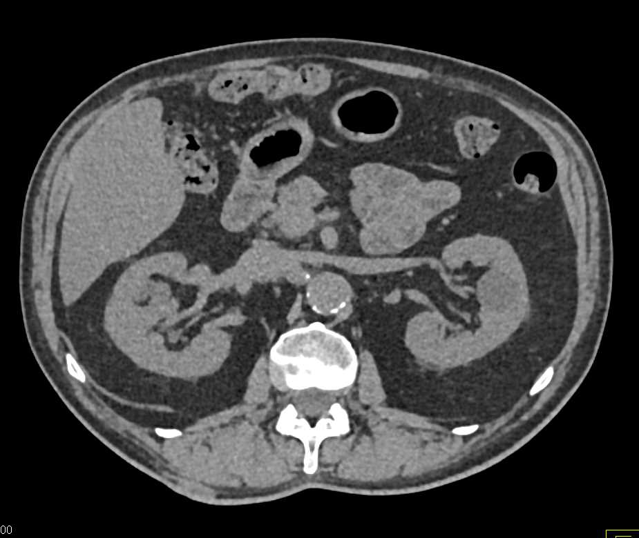 Renal Cell Carcinoma Right Kidney with Arteriovenous (AV) Fistulae ...