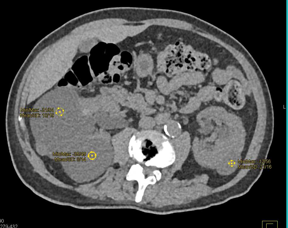 Multiple Bilateral Bosniak I Cysts - CTisus CT Scan