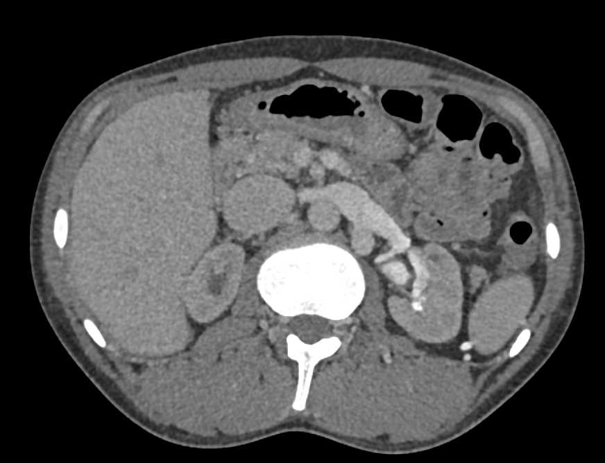 AV Fistulae Left Kidney - CTisus CT Scan