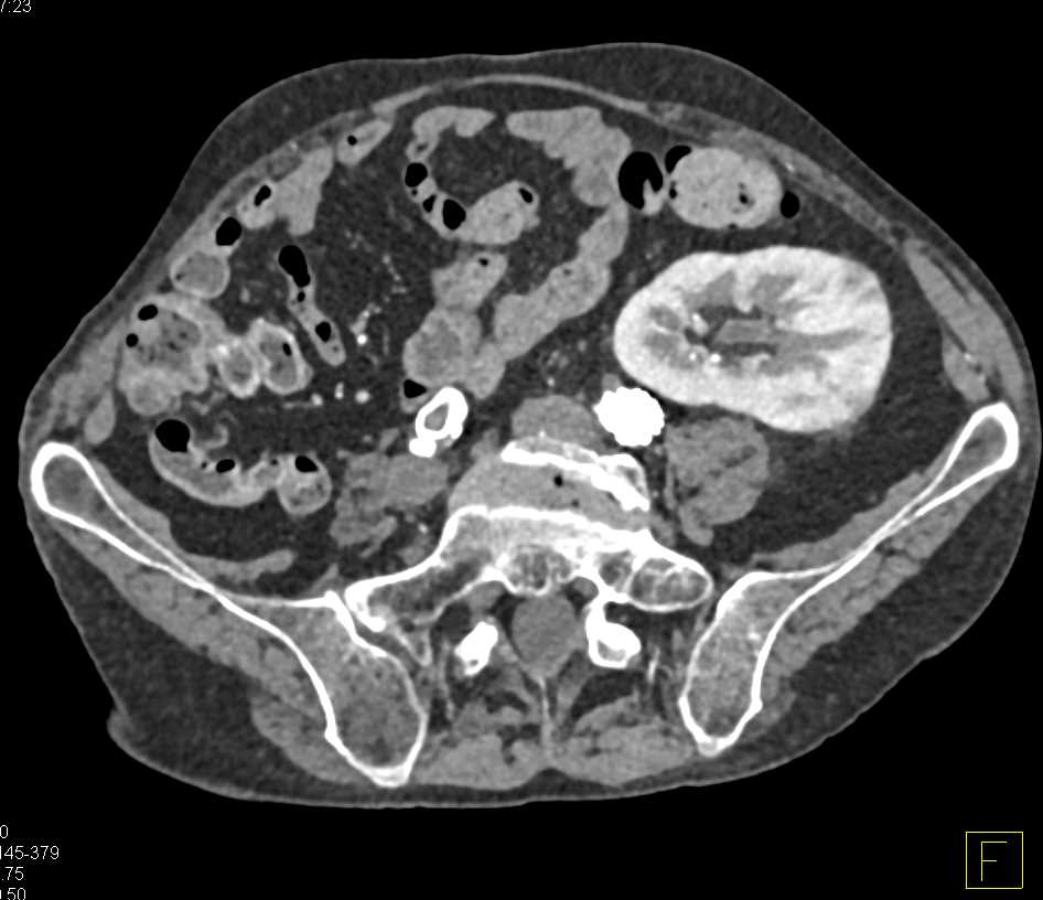 Acute Pyelonephritis in a Transplant Kidney - CTisus CT Scan