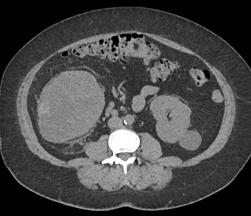 Clear Cell Renal Cell Carcinoma Right Kidney with AV Shunting - CTisus CT Scan
