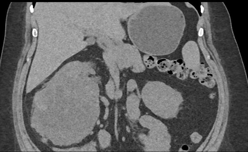 Clear Cell Renal Cell Carcinoma (CCRCC) Invades the Right Renal Vein and the Inferior Vena Cava (IVC) - CTisus CT Scan