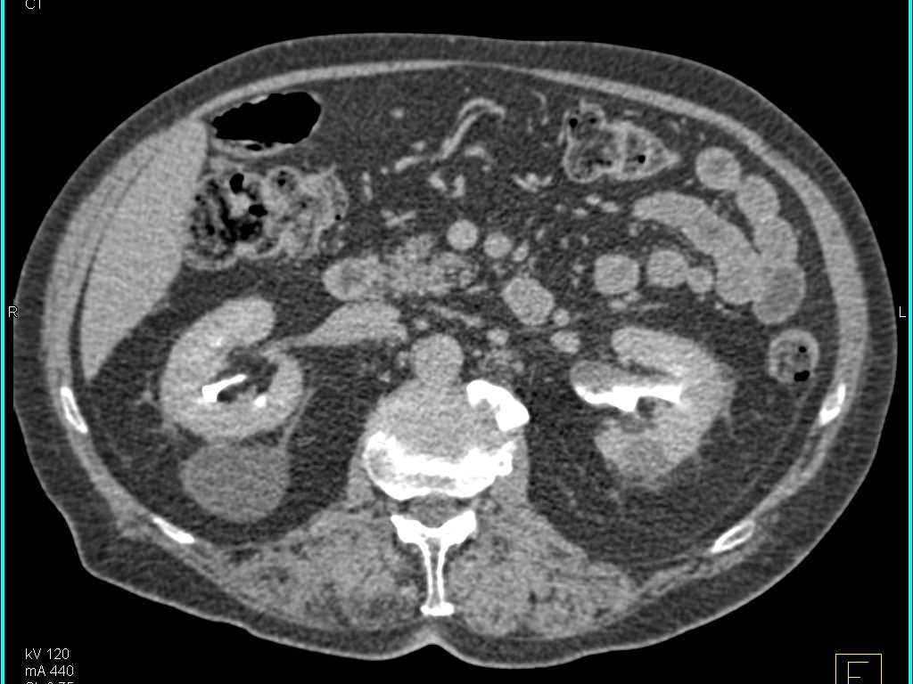 Transitional Cell Carcinoma (TCC) Left Renal Pelvis - CTisus CT Scan