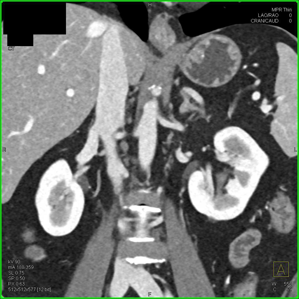 Clot in Lower Pole Calyx Left Kidney - CTisus CT Scan
