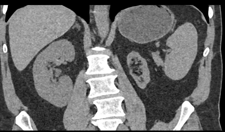 Atrophic Left Kidney - CTisus CT Scan