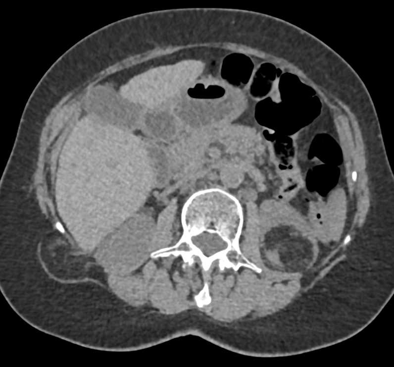 Left Renal Angiomyolipoma - CTisus CT Scan