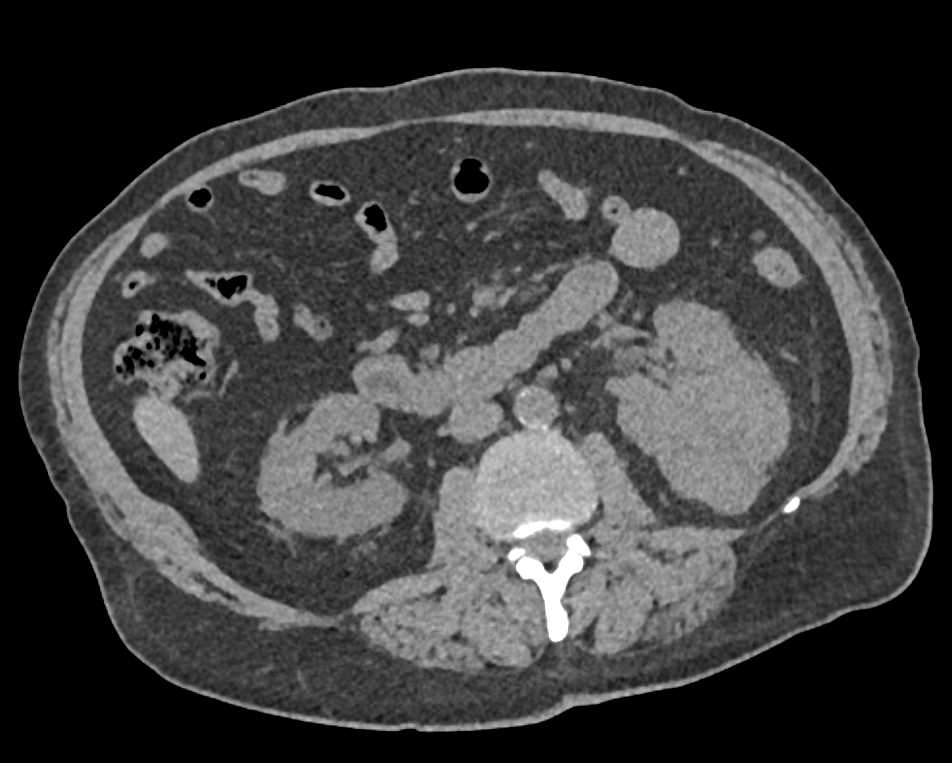 Papillary Left Renal Cell Carcinoma - CTisus CT Scan