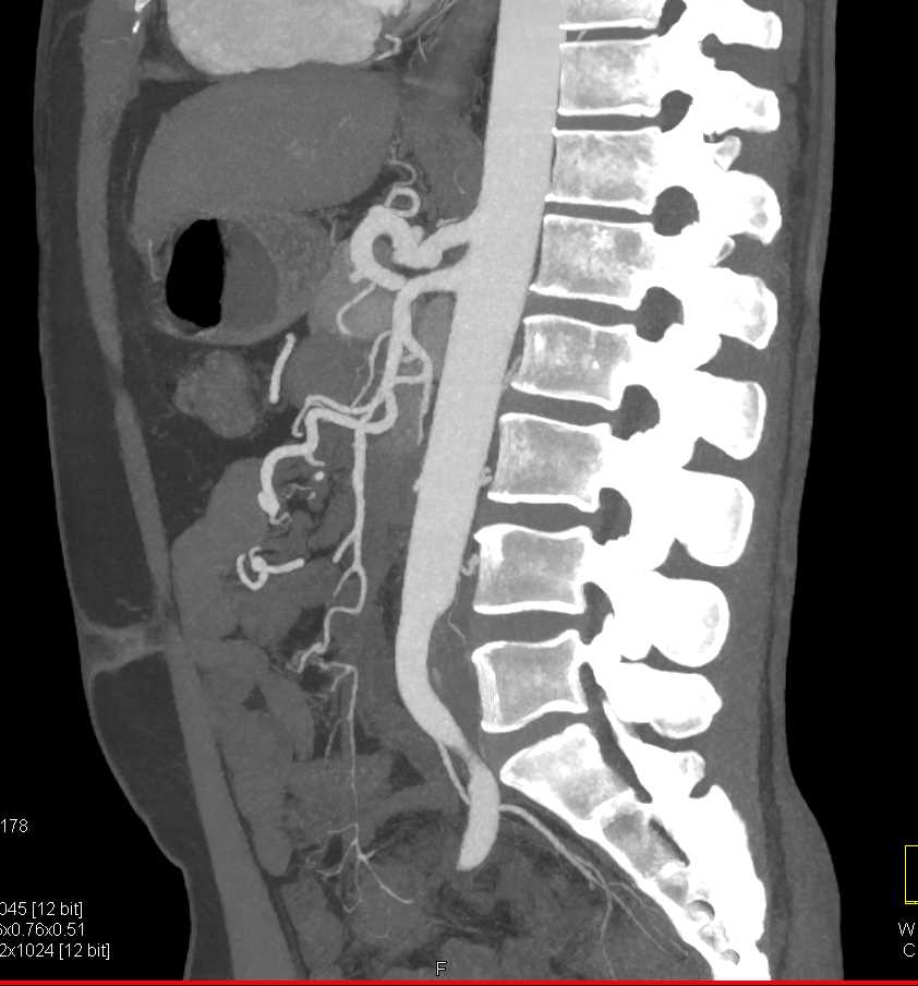 Fibromuscular Dysplasia (FMD) with Beading of the Right Renal Artery and an Aneurysm of the Left Renal Artery - CTisus CT Scan