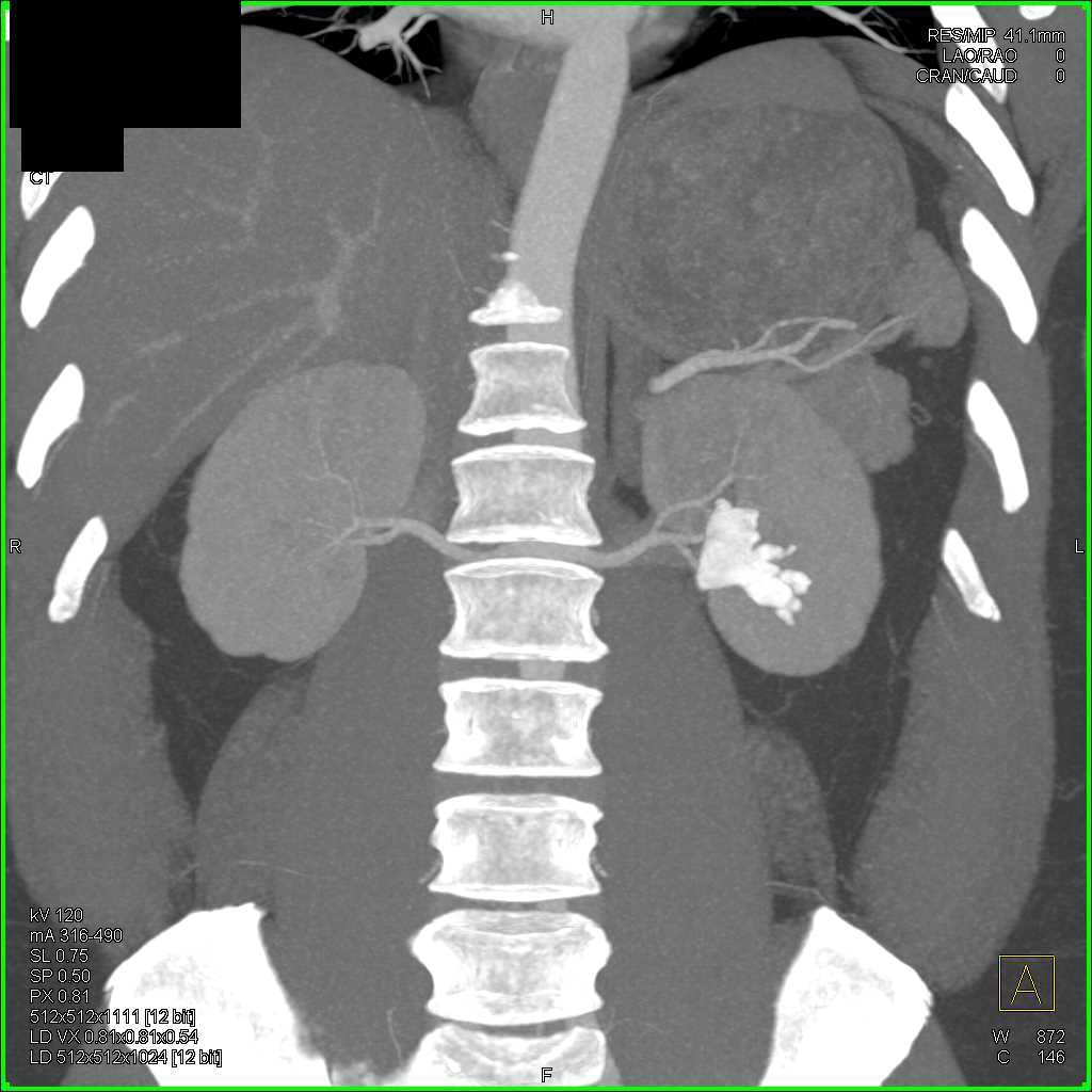 Staghorn Calculus Left Kidney - CTisus CT Scan
