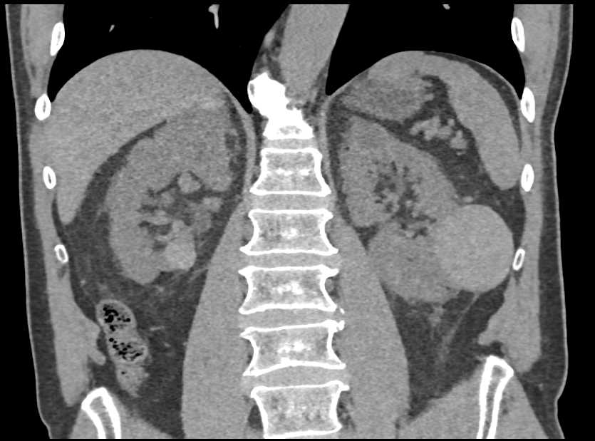 High Density Renal Cysts - Kidney Case Studies - CTisus CT Scanning