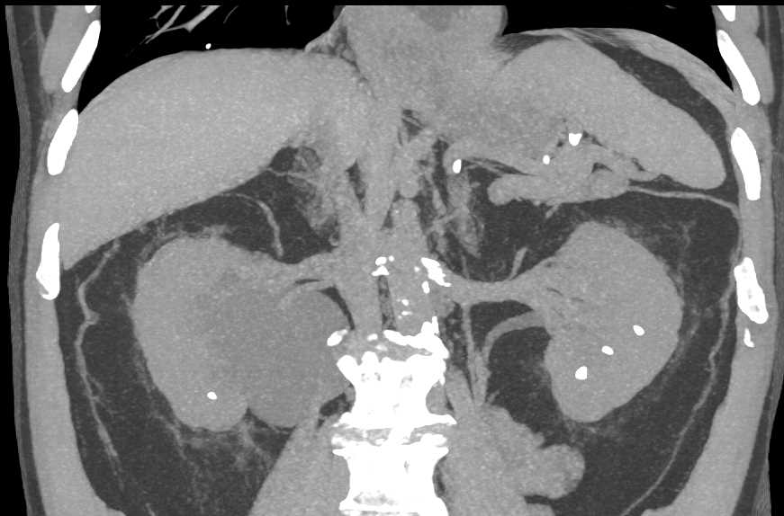 Right Ureteropelvic Junction (UPJ) Stretching the Calyceas - CTisus CT Scan