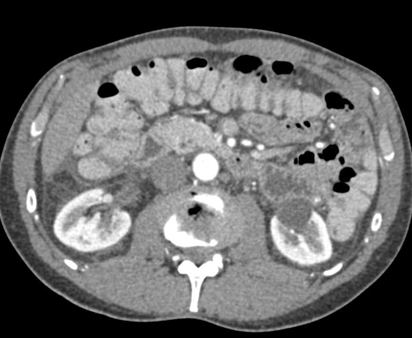 Renal Cysts without Tumor - CTisus CT Scan