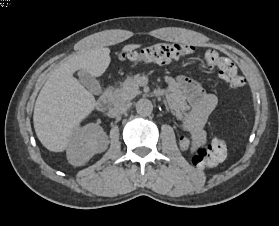 Recurrent Renal Cell Carcinoma in the Contralateral Kidney - CTisus CT Scan