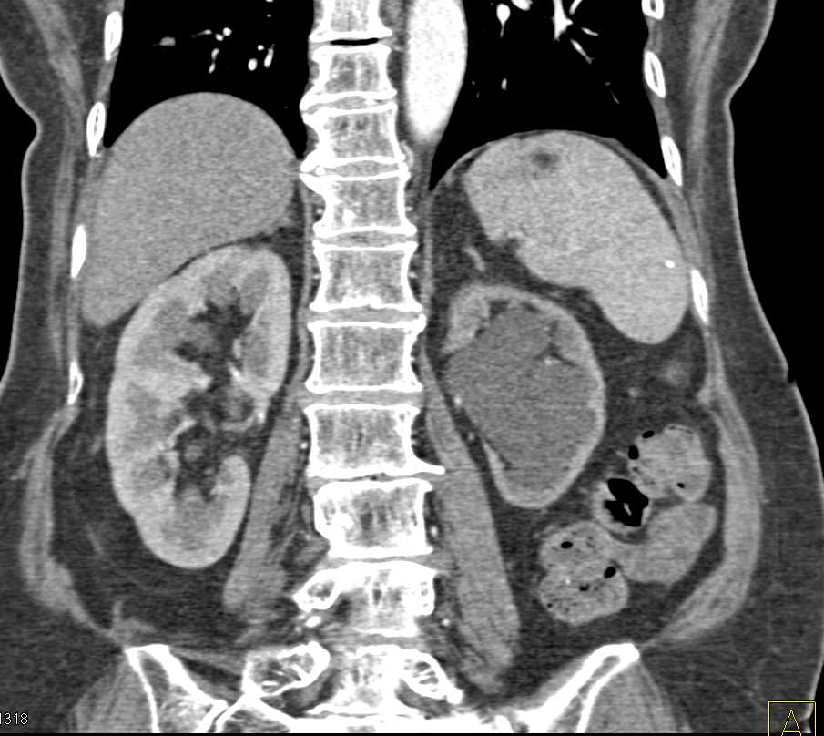 Left Ureteropelvic Junction (UPJ) Obstruction - CTisus CT Scan