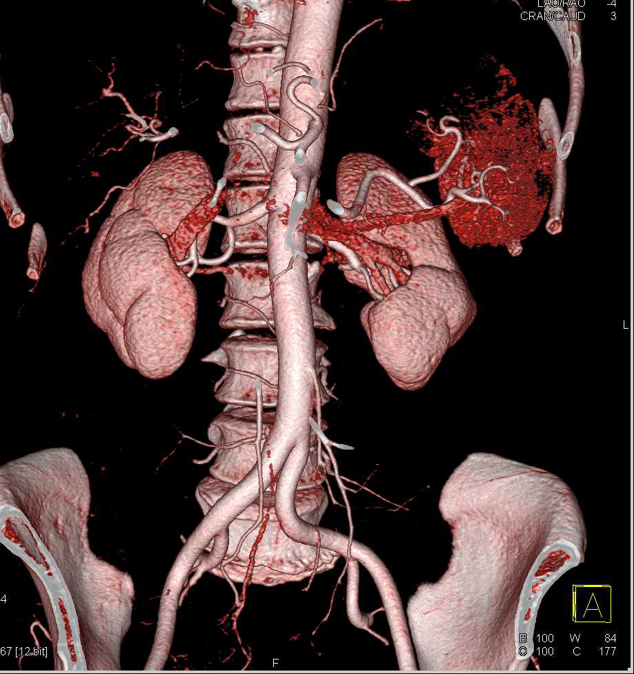 CTA of the Normal Kidneys - CTisus CT Scan