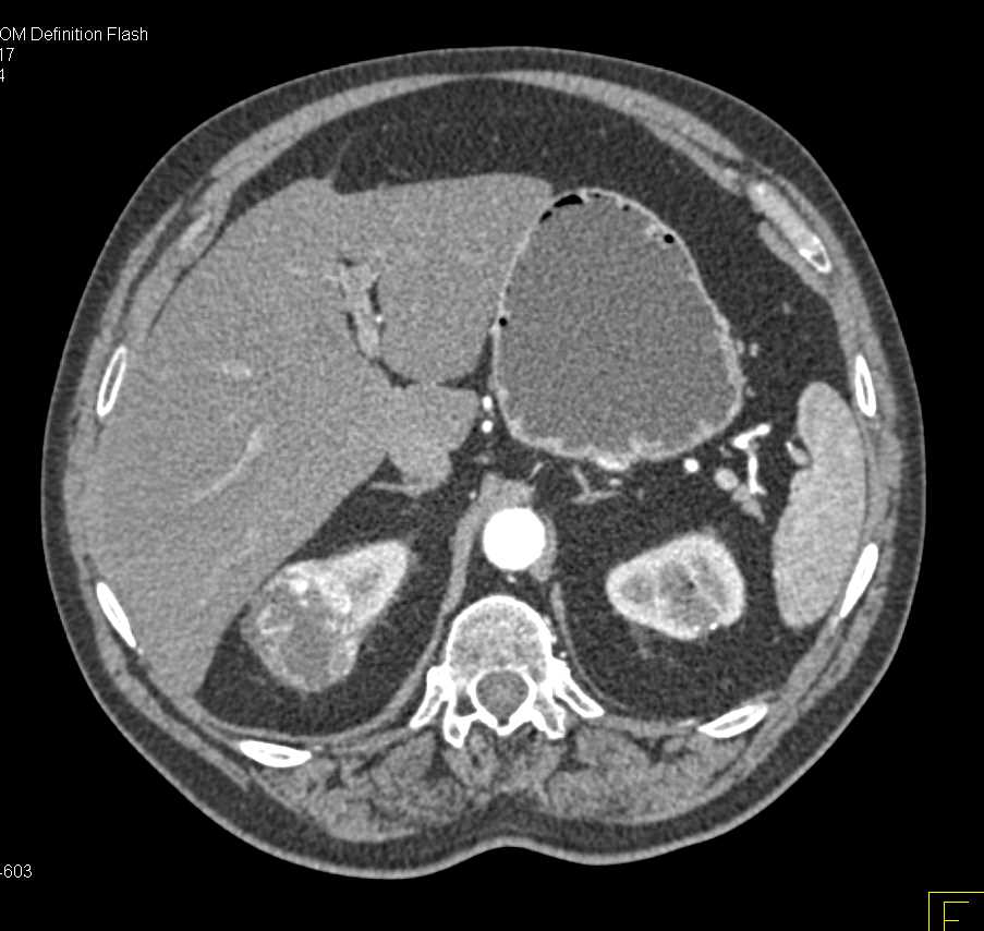 Clear Cell Renal Cell Carcinoma - CTisus CT Scan