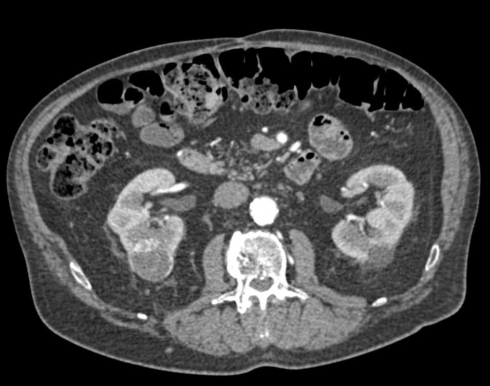 Cystic Renal Cell Carcinoma Lower Pole Right Kidney - CTisus CT Scan