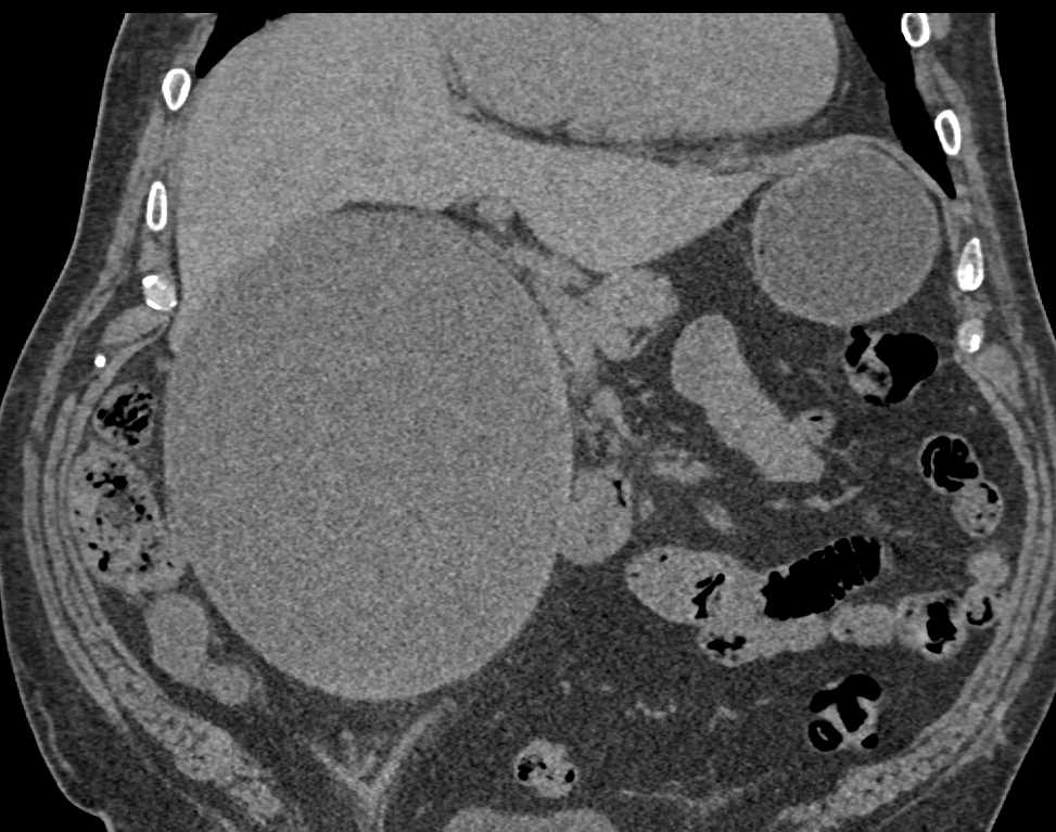 Complex Right Renal Cyst - CTisus CT Scan