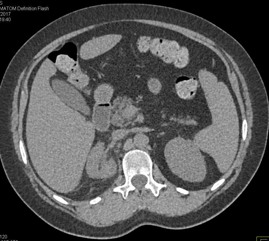 Acute Pyelonephritis Right Kidney - CTisus CT Scan